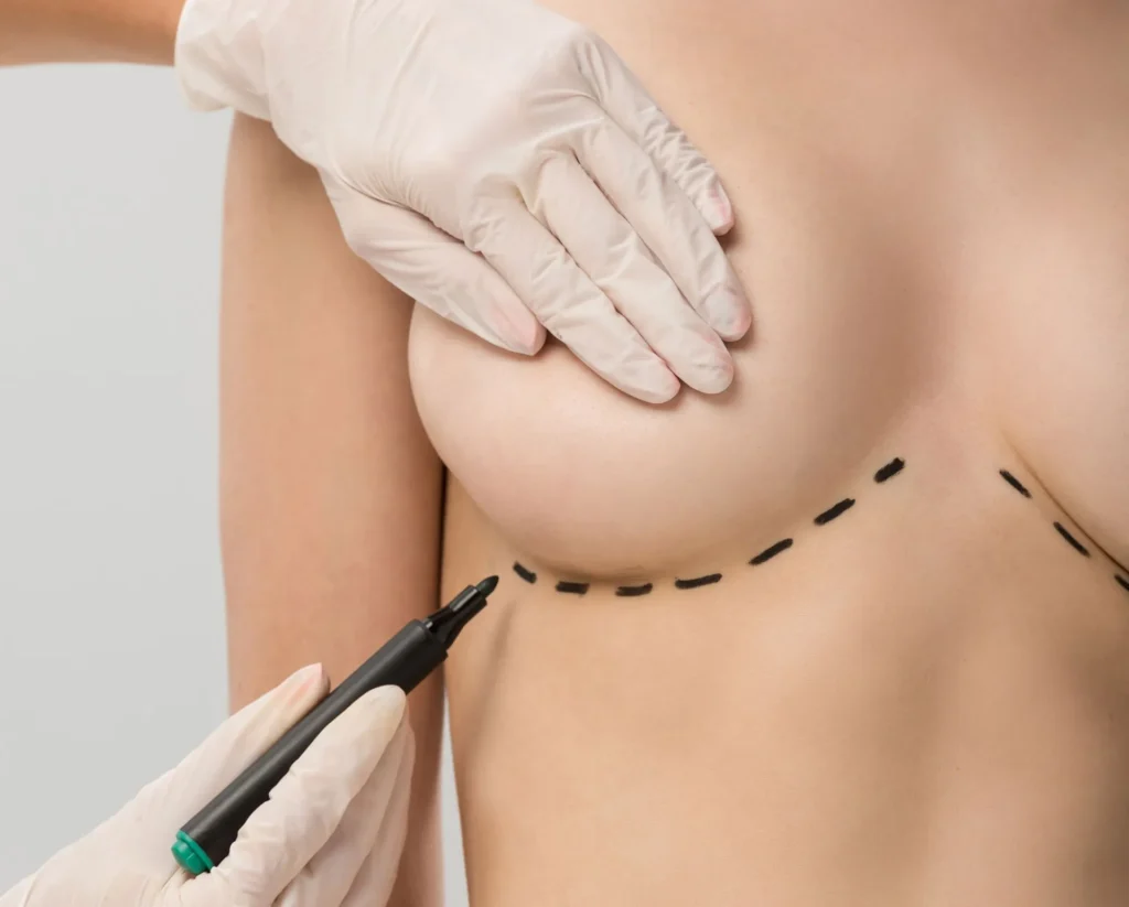Aumento de busto con resultados naturales