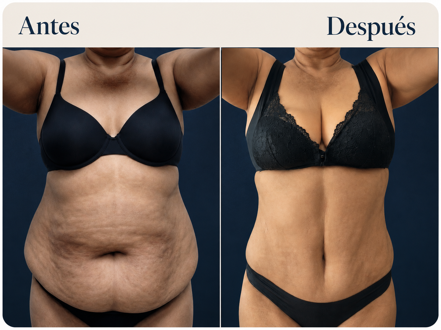 Lipoescultura